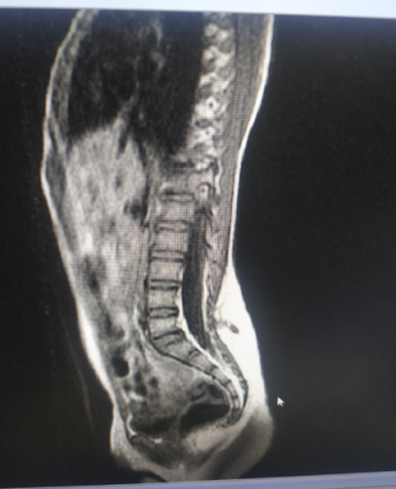 Seno dérmico lumbar - Opción Médica